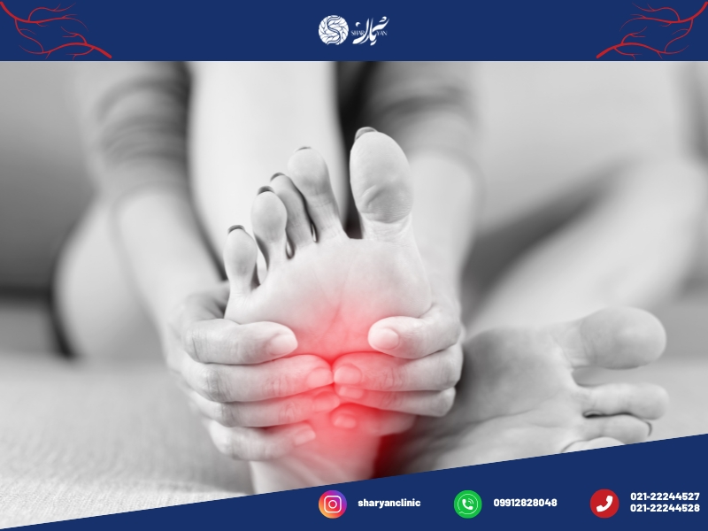 واریس چیست؟|علائم،پیشگیری و درمان آن 4 علائم