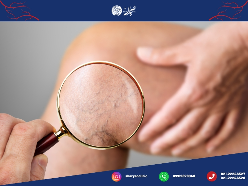 واریس چیست؟|علائم،پیشگیری و درمان آن 1 واریس چیست؟