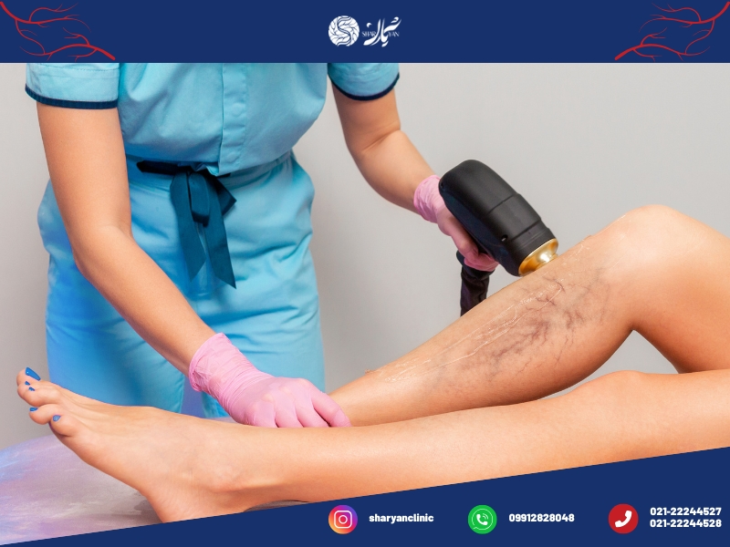 واریس چیست؟|علائم،پیشگیری و درمان آن 5 درمان های واریس