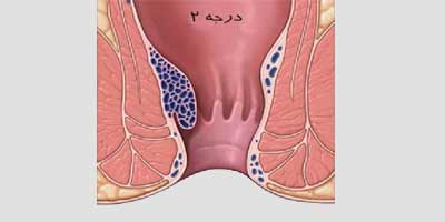Hemorrhoids 1