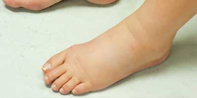 Leg swelling