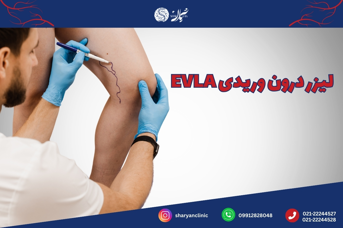 لیزر درون وریدی EVLA