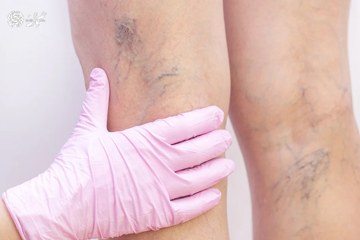 بهترین متخصص واریس در تهران: درمان غیرجراحی و موثر واریس در کلینیک شریان 10 کلینیک واریس شریان