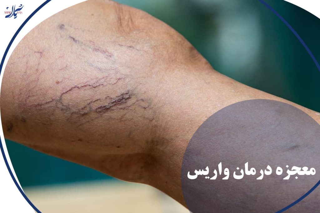 درمان واریس