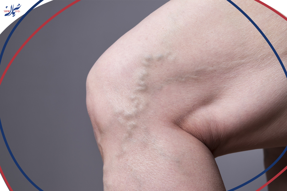 عمل واریس پا (روشهای نوین بدون بیهوشی و بخیه) | کلینیک شریان 1 واریس پا و ضرورت انجام عمل