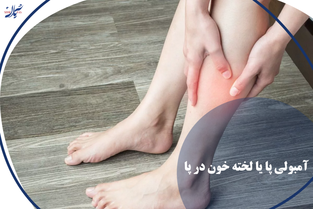 لخته خون در پا