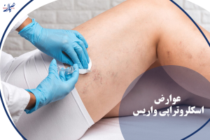 عوارض اسکلروتراپی واریس