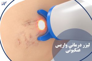 لیزر درمانی واریس عنکبوتی