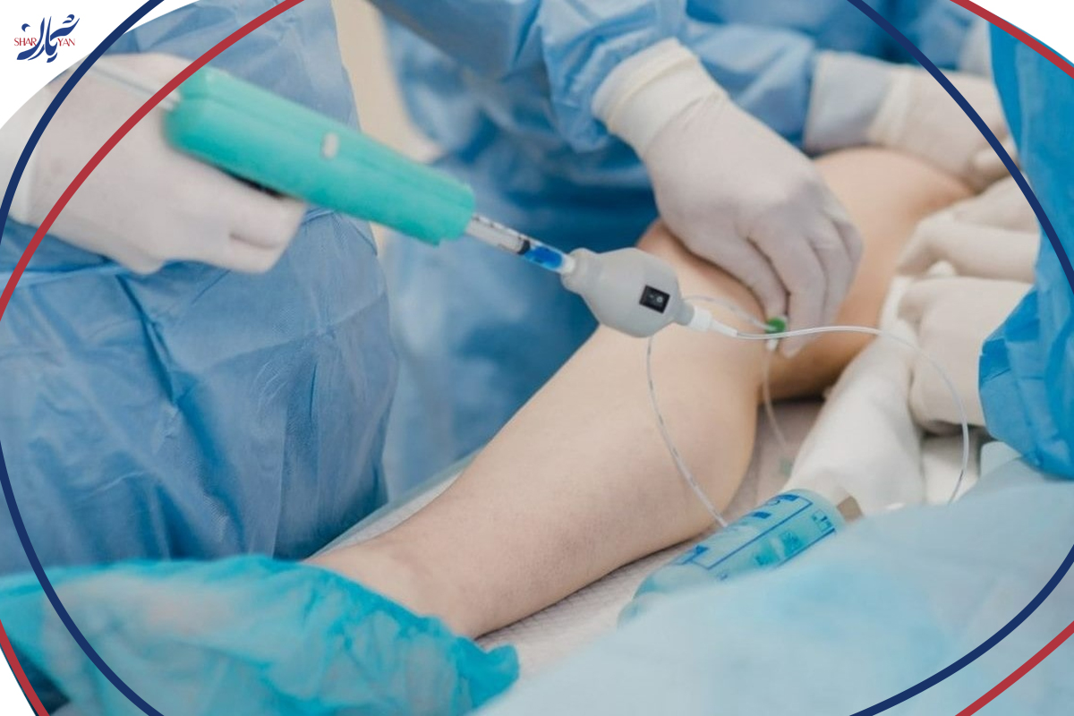 تاثیر گرما بر عروق واریس با قرارگرفتن در جکوزی و سونا چیست؟ 3 درمان تخصصی واریس