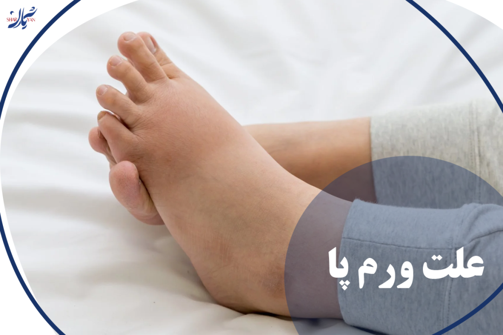 علت ورم پا