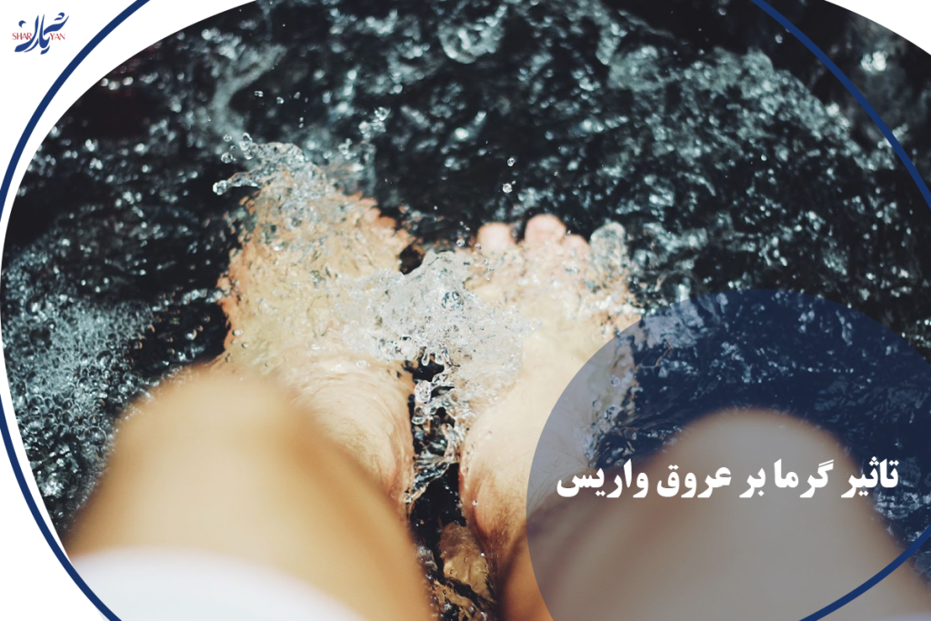 تاثیر گرما بر عروق واریس