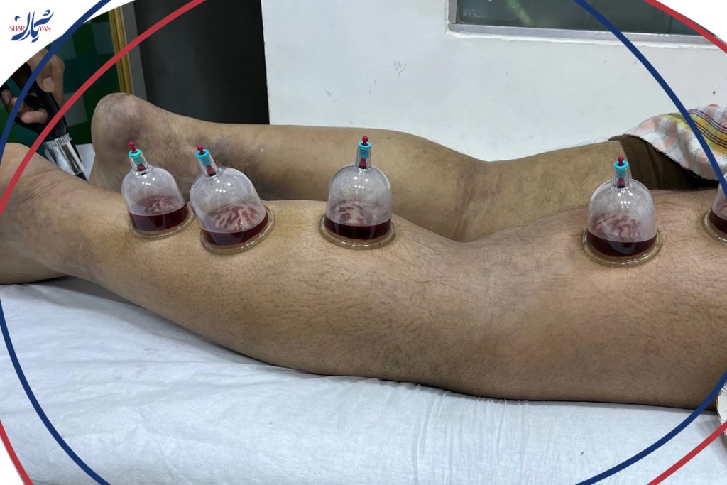 Cupping or foot leech therapy