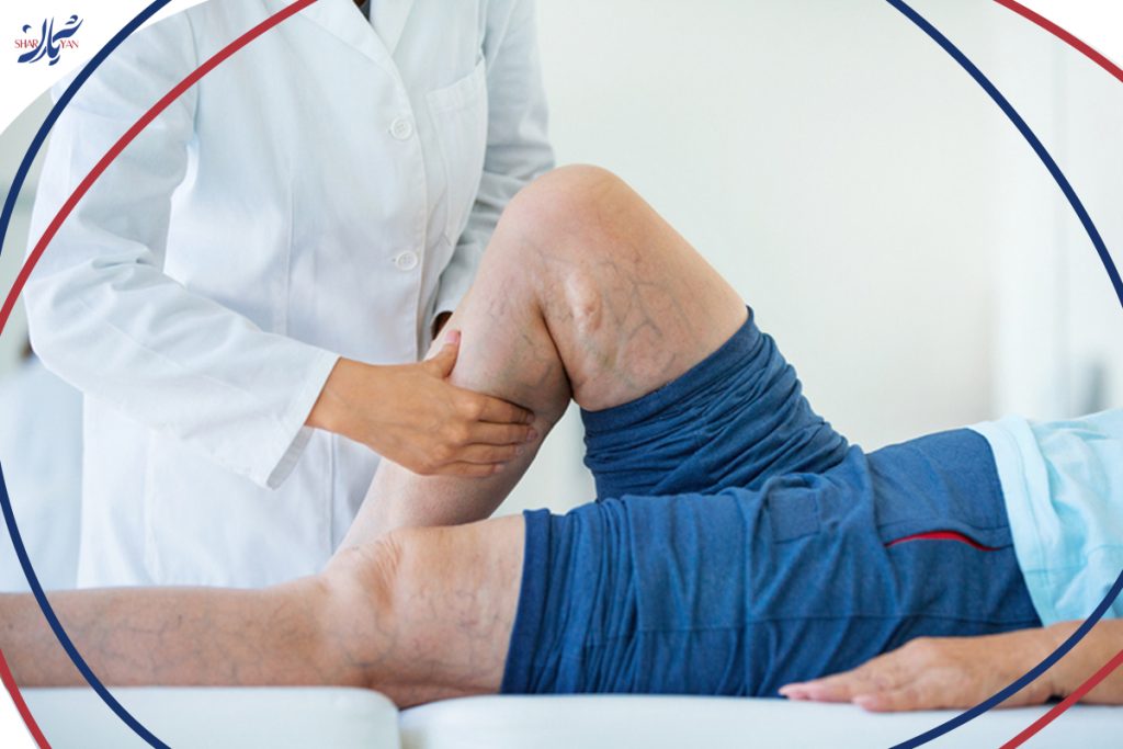 Treating varicose veins with physiotherapy at home