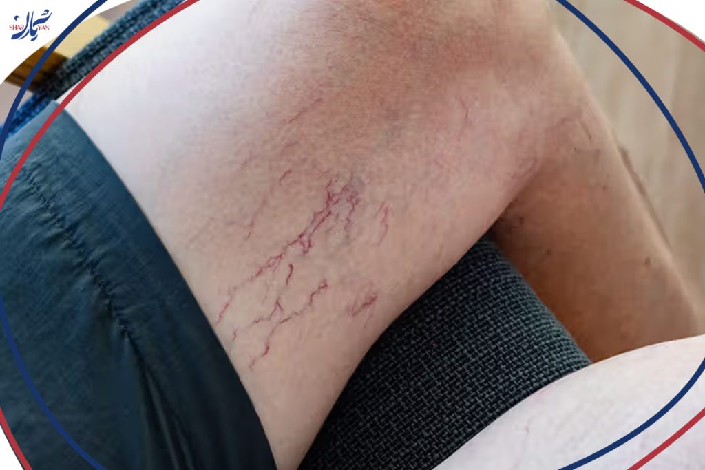 استفاده از فلفل قرمز برای درمان واریس پا