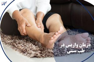 درمان واریس در طب سنتی