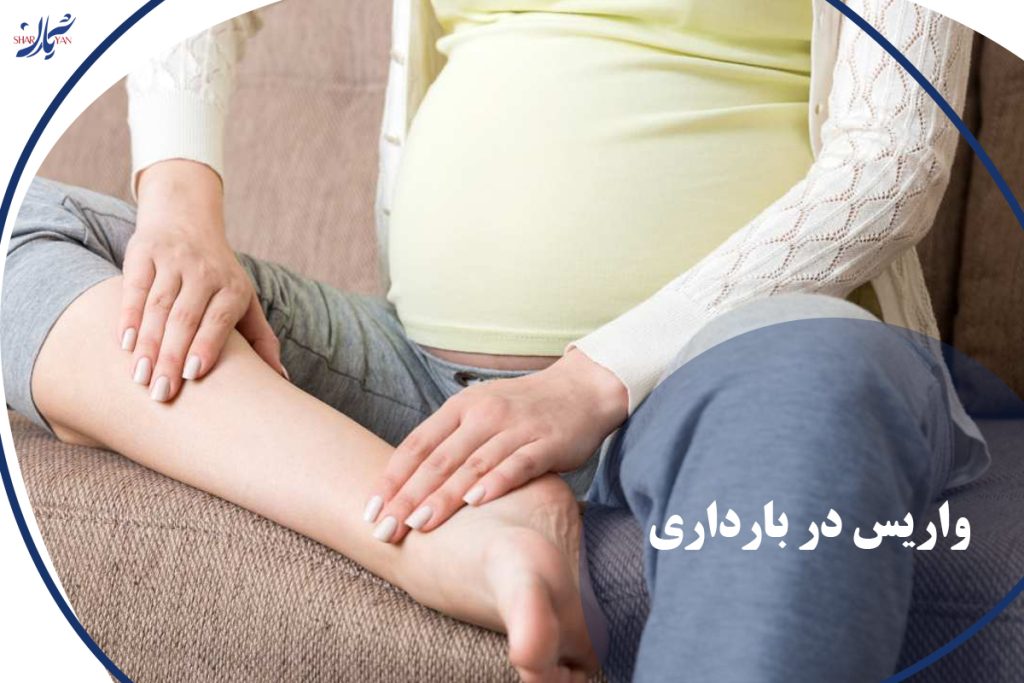 واریس در بارداری