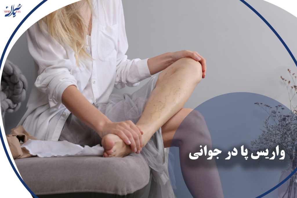 واریس پا در جوانی