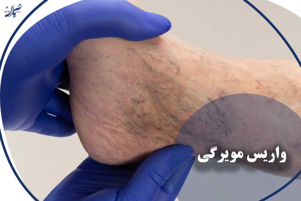 واریس مویرگی