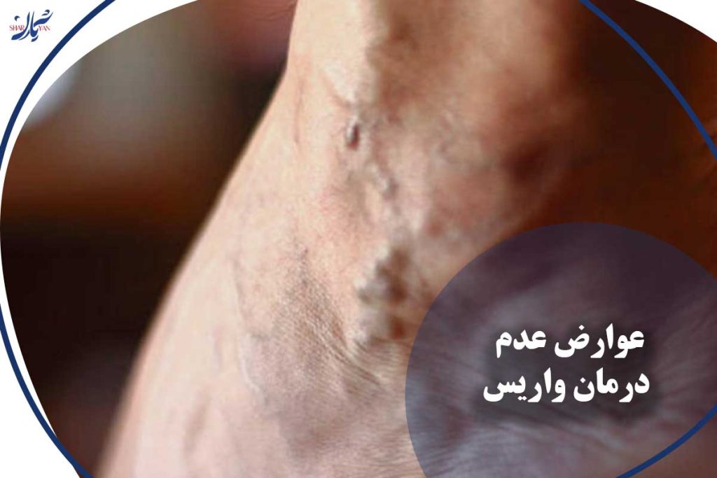 عوارض عدم درمان واریس