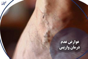 عوارض عدم درمان واریس