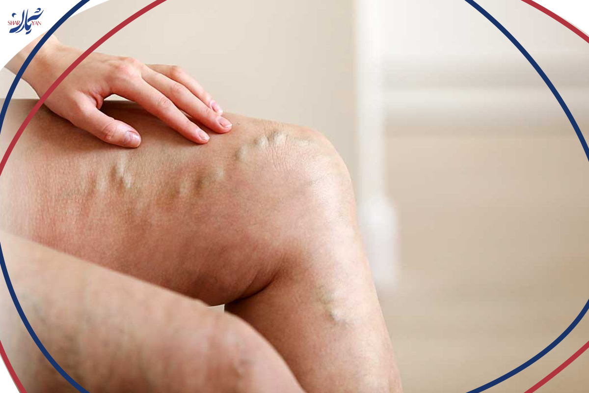واریس طنابی چیست و چگونه درمان میشود؟ 6 عوارض عدم درمان واریس طنابی