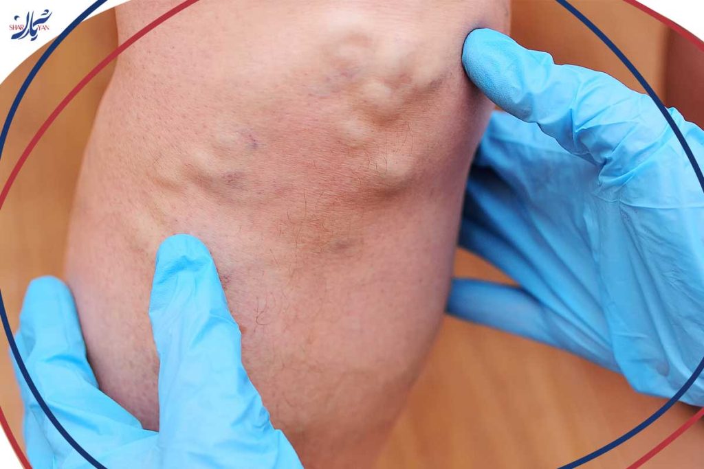 Contraindications to sclerotherapy