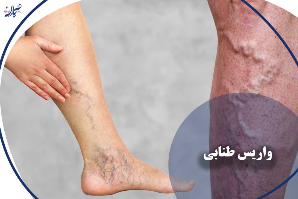 واریس طنابی