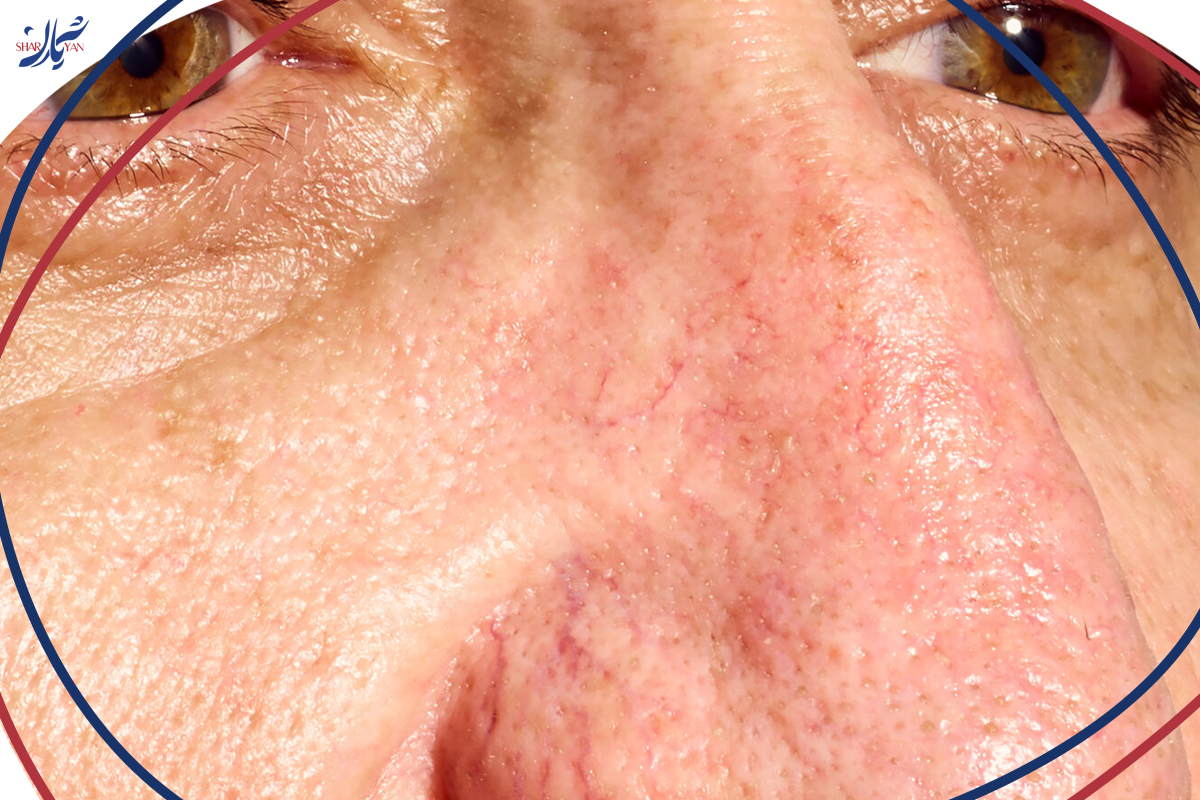 درمان واریس صورت با لیزر در کلینیک شریان 2 علائم و نشانههای واریس صورت