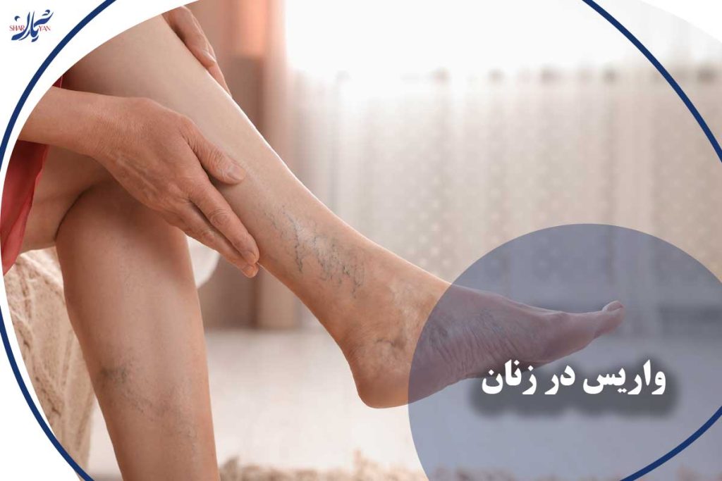واریس در زنان