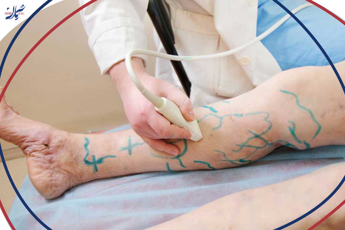 استفاده از فلبکتومی در درمان واریس 6 مقایسه فلبکتومی با سایر روشهای درمان واریس