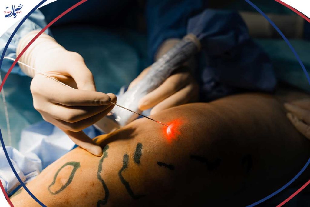 Laser treatment of varicose veins