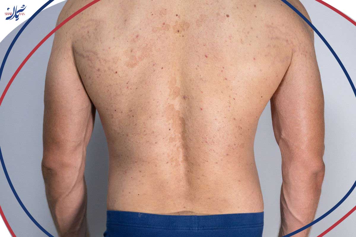 واریس کمر چیست و چرا کمتر شناخته شده است؟ 2 تغییر رنگ پوست در ناحیه کمر