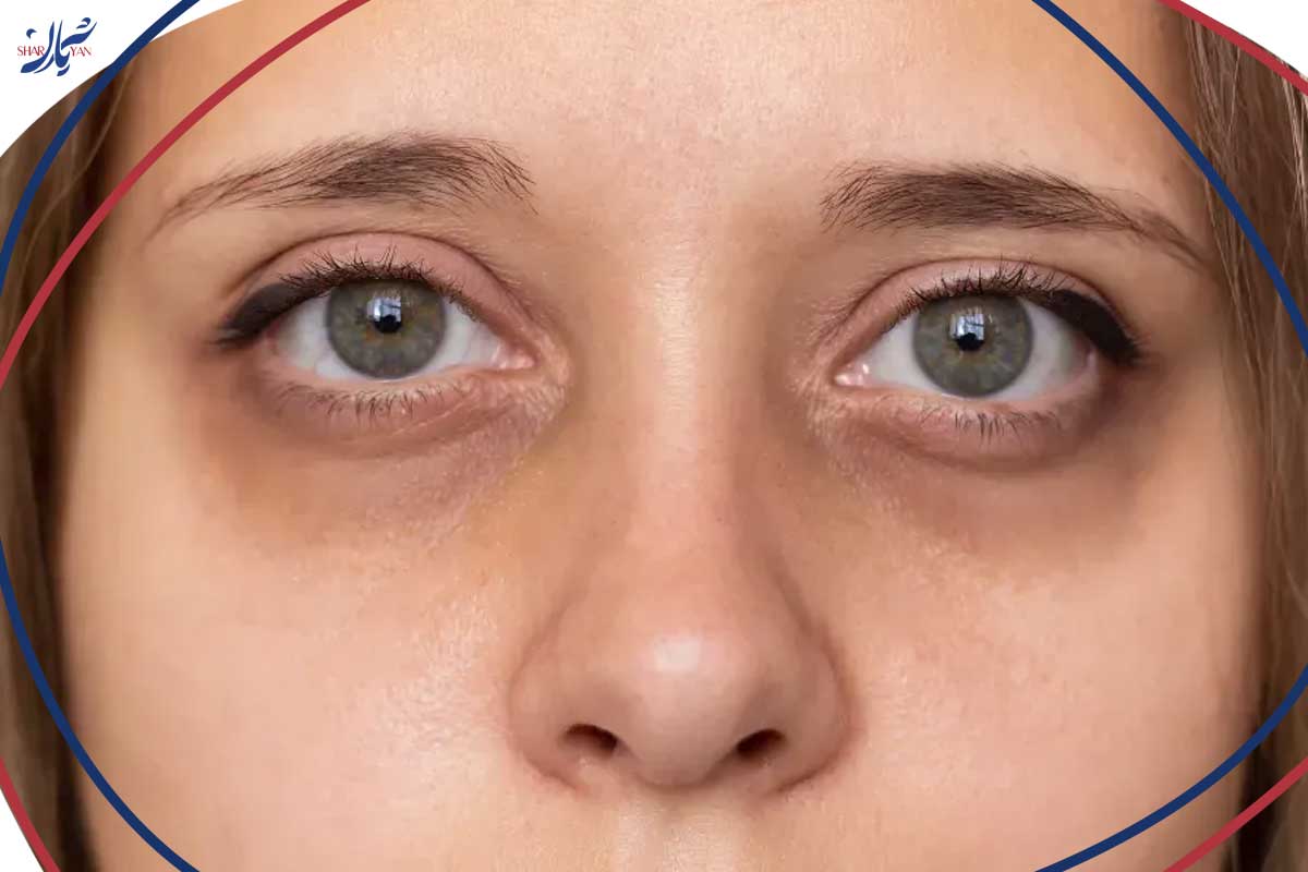 واریس زیر چشم چیست و چگونه میتوان آن را از بین برد؟ 1 علت مشخص شدن رگ زیر چشم