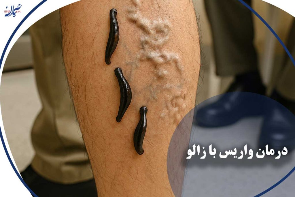 درمان واریس با زالو