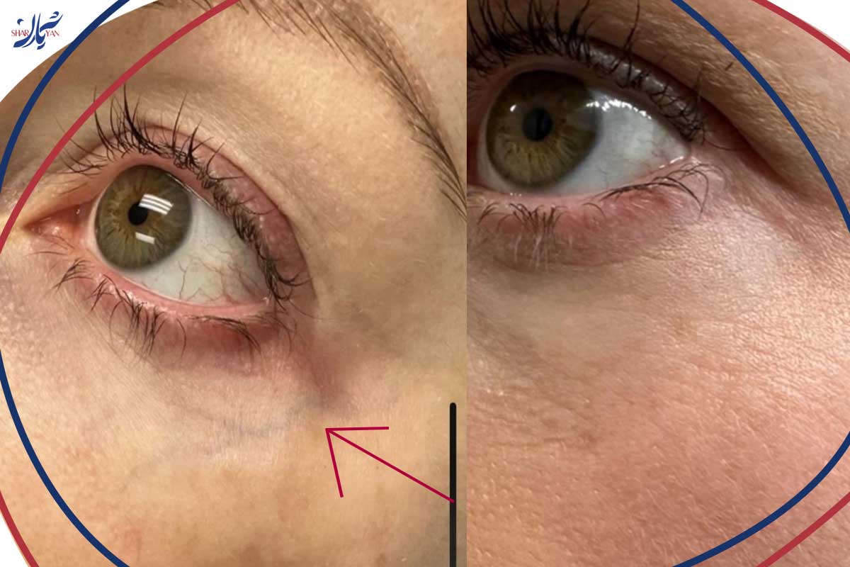 واریس زیر چشم چیست و چگونه میتوان آن را از بین برد؟ 3 درمان رگهای واریسی زیر چشم