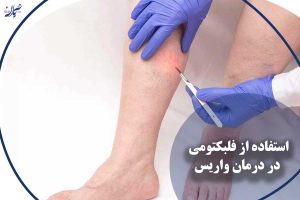 استفاده از فلبکتومی در درمان واریس
