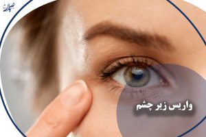 واریس زیر چشم