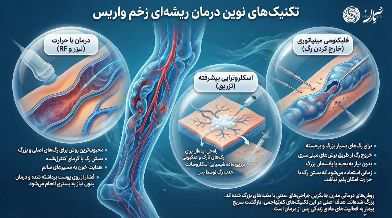 بهترین پماد برای درمان زخم واریس 4 تکنیکهای درمانی پیشرفته زخم واریس