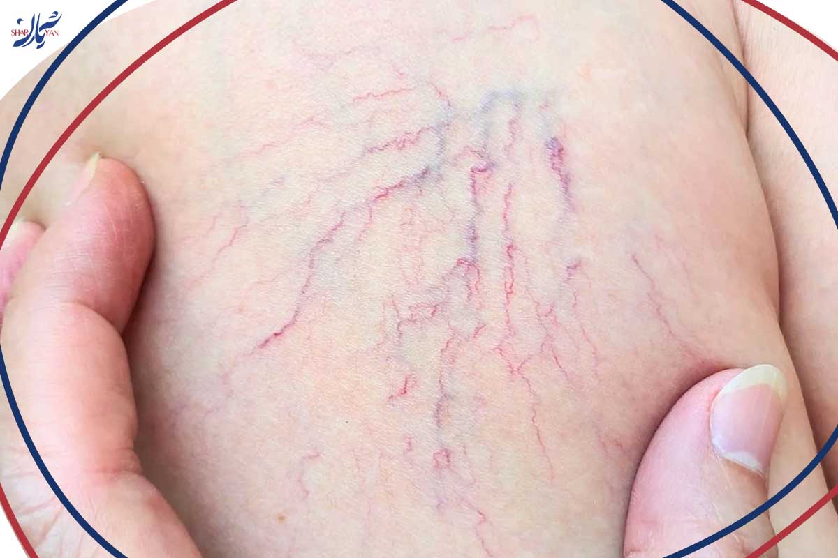 دلایل نمایان شدن رگ های بنفش روی پا | روشهای پیشگیری و درمان 5 پیامدهای واریس عنکبوتی