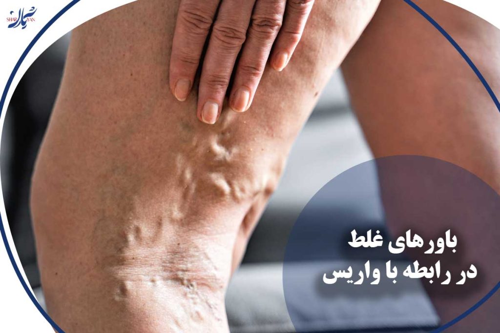 باورهای غلط در رابطه با واریس