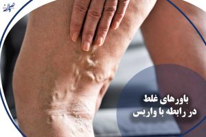 باورهای غلط در رابطه با واریس