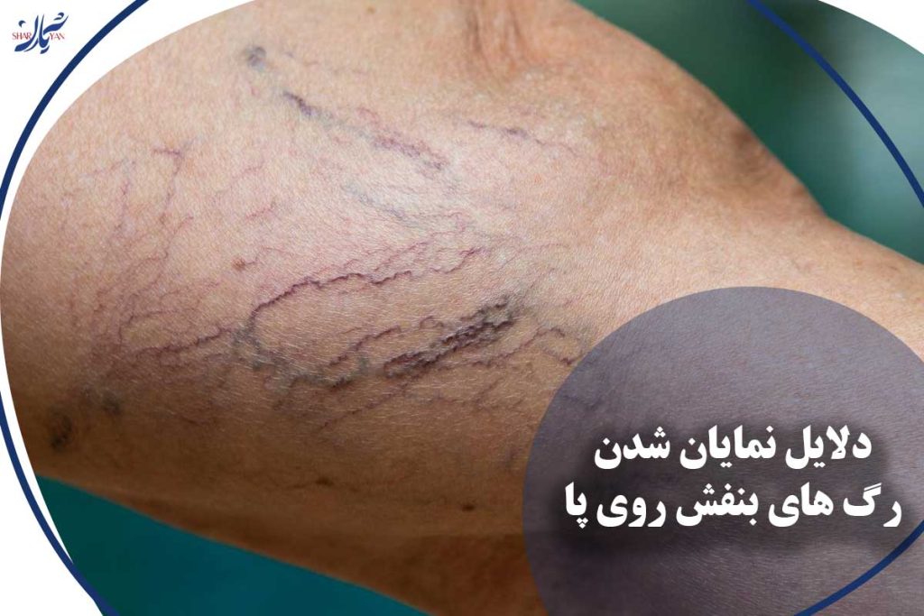 رگ های بنفش روی پا