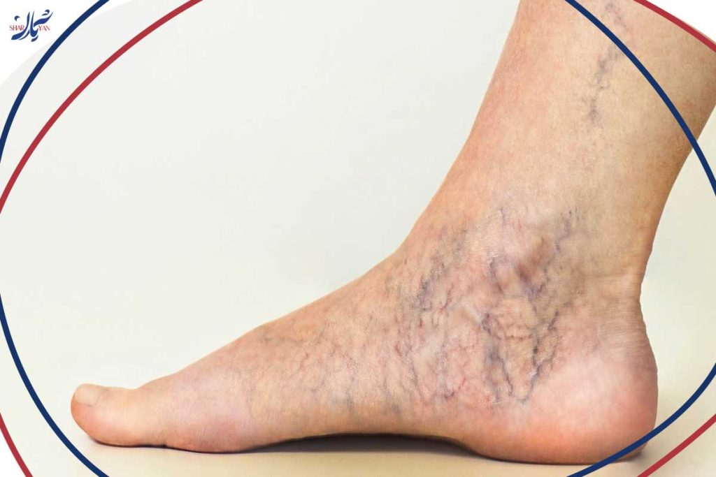 Spider veins
