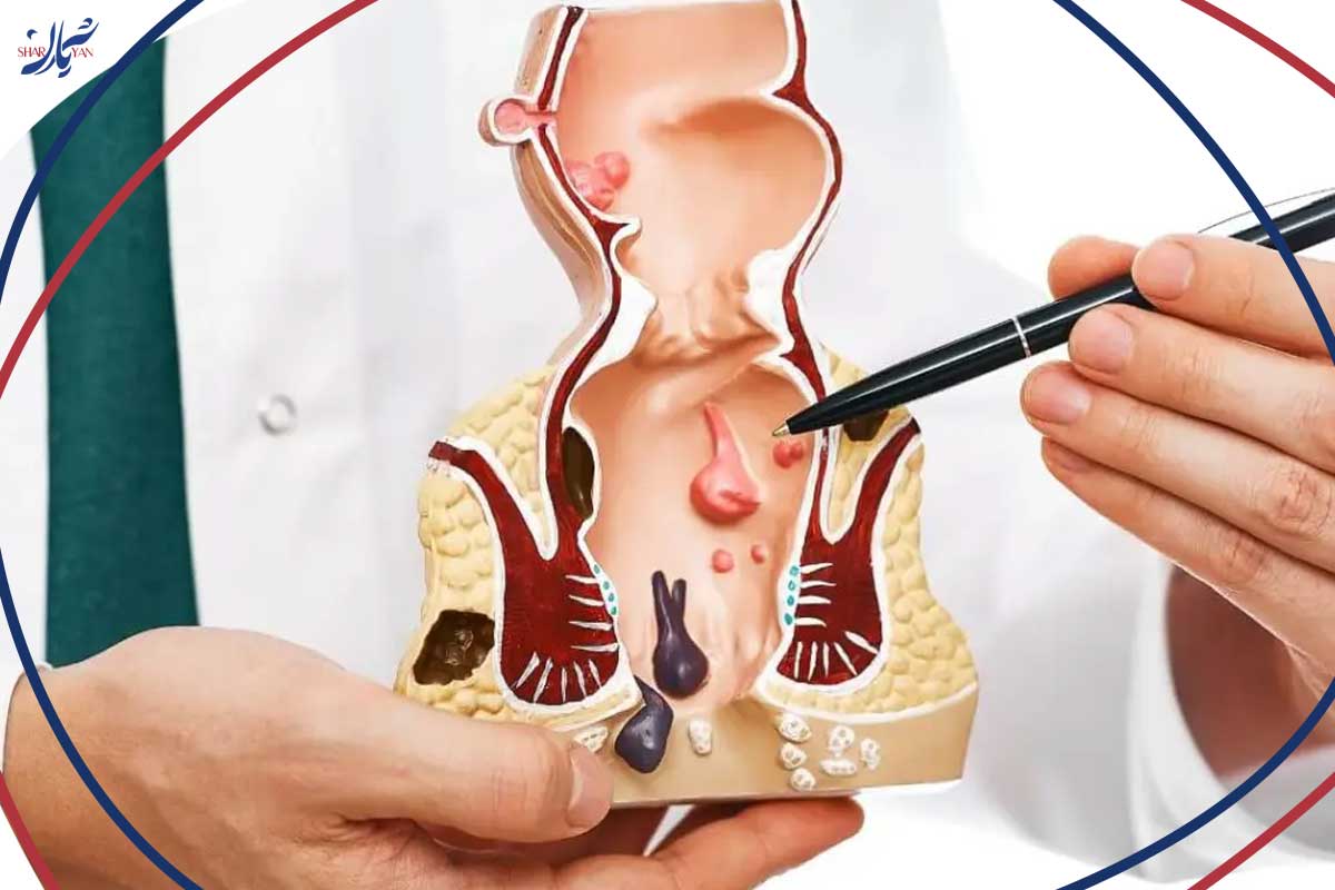 واریس یا وریکوسل خطرناک 