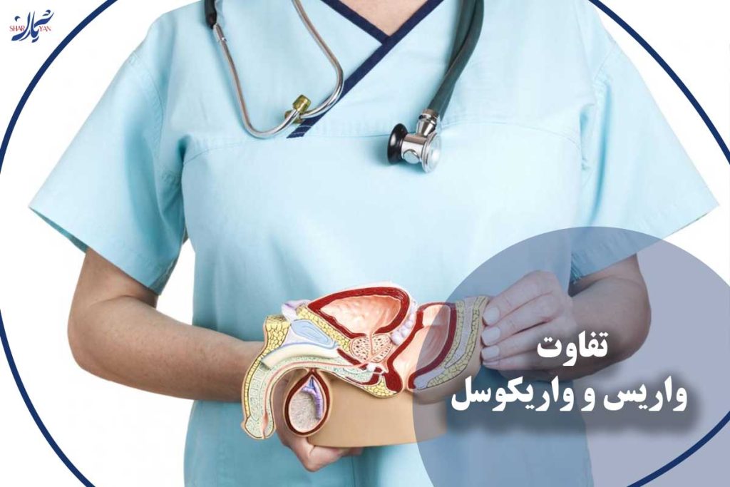 تفاوت واریس و واریکوسل