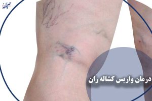 درمان واریس کشاله ران