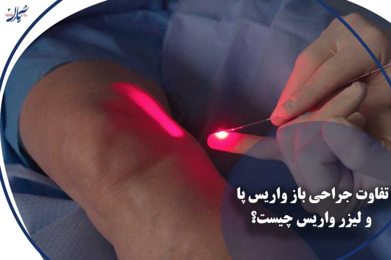 تفاوت جراحی باز واریس پا و لیزر واریس