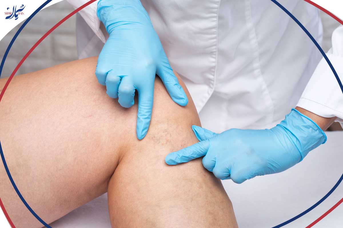 تفاوت جراحی باز واریس پا و لیزر واریس 