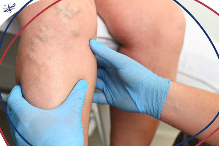 The difference between open varicose vein surgery and varicose vein laser in terms of benefits