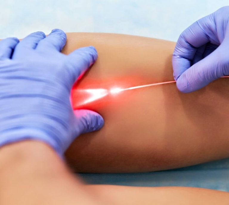 endovenous laser ablation 1
